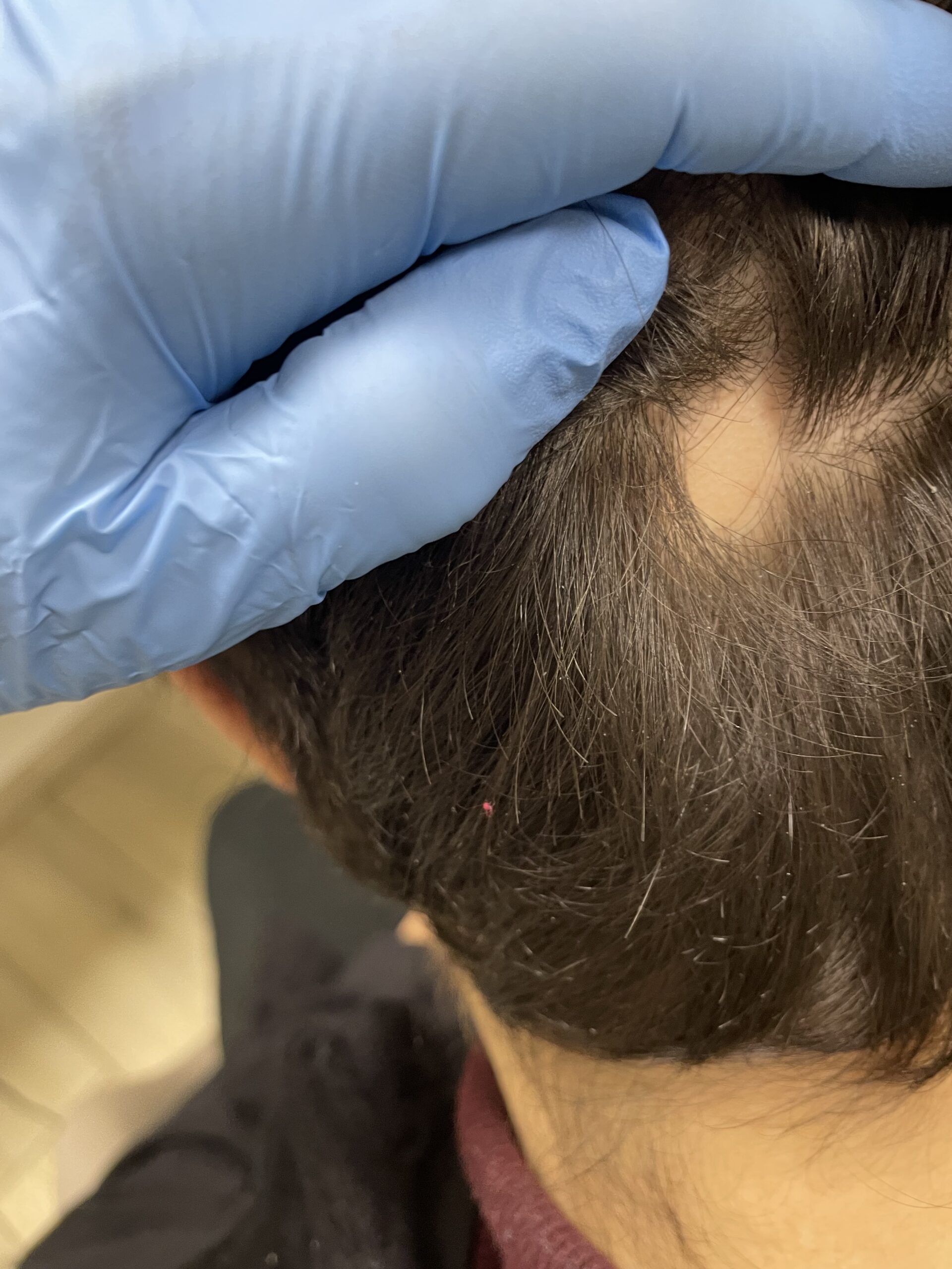 Choć pielęgnacja włosów i skóry głowy nie zapobiegnie chorobie, to odpowiednia dbałość o kondycję włosów może wspierać osoby, którym łysienie plackowate dokucza. Milena Trycholog Bydgoszcz